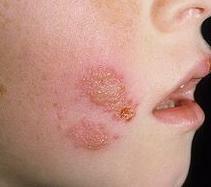 Herpes på ansiktsfoto
