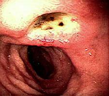 Ulcera del duodeno