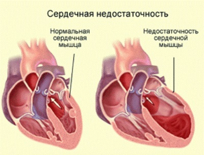 Cause di insufficienza cardiaca cronica