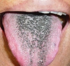 Plaque noire dans la langue