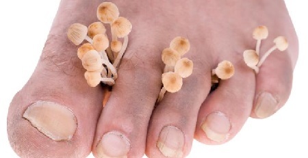 Pilz des Fußes - Symptome und Behandlung, Foto