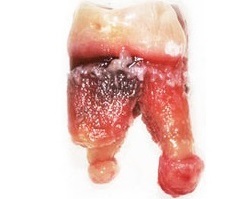 Kyste sur la racine des symptômes de la dent