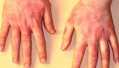 Sintomas de dermatite de contato