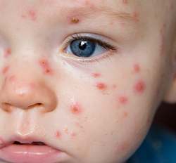 Chickenpox hos barn