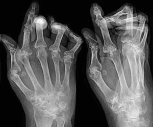 Sintomi e tattiche del trattamento dell'artrite reumatoide con rimedi popolari
