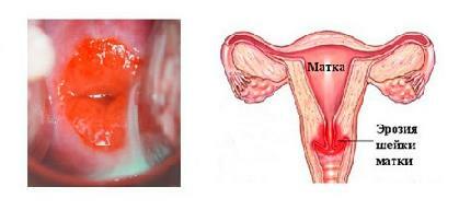 Erosion des Gebärmutterhalses - Ursachen, Symptome und Behandlung