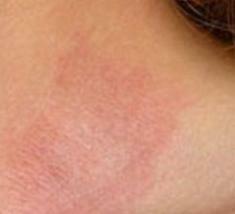 Traitement de la dermatite allergique