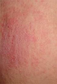 Foto der allergischen Dermatitis
