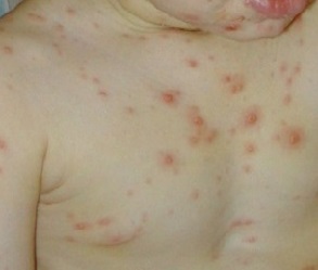 sintomas de varicela