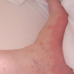 Allergiás urticaria a lábán