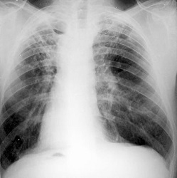 Tuberkulóza - příznaky a první příznaky