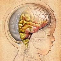 דלקת קרום המוח - תסמינים אצל מבוגרים וילדים, טיפול