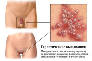 Dzimumorgānu herpes vīriešiem un sievietēm