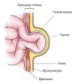 Umbilical hernia: symptoms and treatment in adults