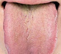 Grüne Beschichtung auf der Zunge