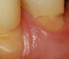 Cuneoid tooth defect