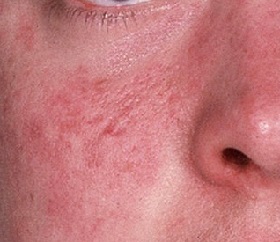 Foto di dermatite sul viso