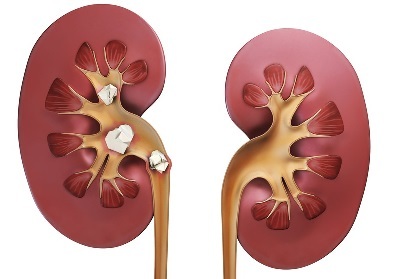 Kidney stones - symptoms, diet and treatment
