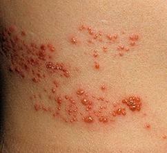 Herpes på kroppen - orsaker och behandling