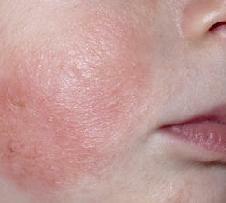 Atópiás dermatitis tünetei