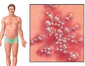 genitální herpes 2