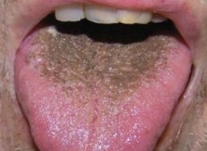 Plaque noire dans la langue: causes et traitement