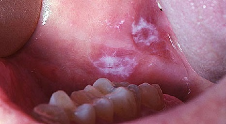 Tratamiento de la cavidad oral de leucoplasia