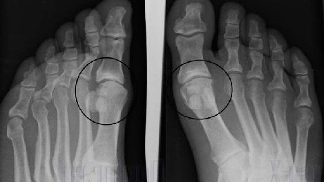 Foto jalgade artroos on röntgenograafia.