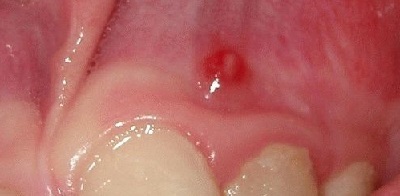 Cyst hampaan juuressa - oireet, hoito, poisto