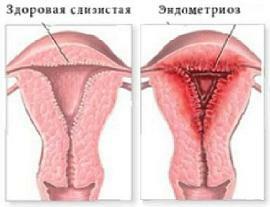 Síntomas de endometriosis