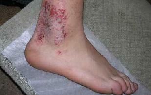 Mikrobiální ekzém na rukou a nohou