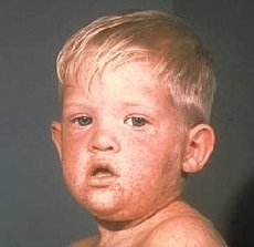 Measles in children