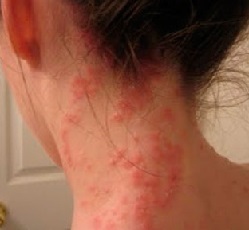 Allergisk urtikaria