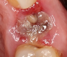 Alvéolite après extraction dentaire - symptômes et traitement