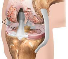 Artritis simptoma zglobova koljena