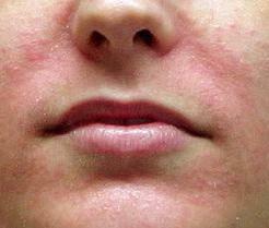 Seborrheski dermatitis na obrazu