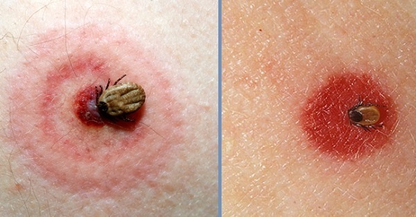 Se houver vermelhidão na mordida - esta pode ser uma reação alérgica normal. Mas as manchas vermelhas que atingiram um diâmetro de 10-12 cm, podem ser um sintoma da doença de Lyme