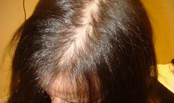 Alopecia hos kvinner