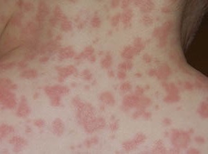 Hogyan mutat az allergia az antibiotikumok után?