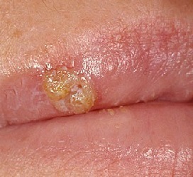 How to quickly cure herpes on the lips at home?