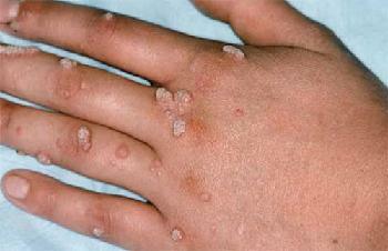 Humane papillomavirus symptomer