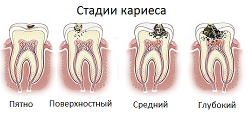Caries dentaires - photo, prévention et traitement