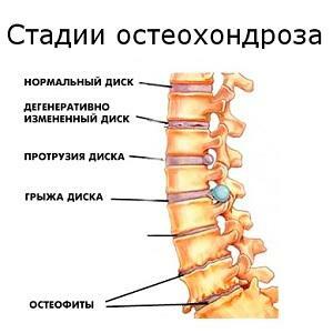 Cómo tratar la osteocondrosis de la columna vertebral