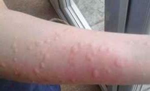 Allergi for kaldt på ansikt og hender - symptomer og behandling, foto
