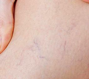 דליות ורידים על הרגליים: סימפטומים וטיפול