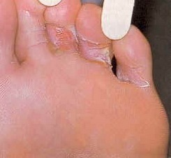 Pilz der Fußsymptome