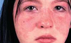 Systemiska lupus erythematosus symptom