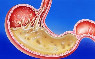 Aumento de la acidez del estómago - síntomas y tratamiento