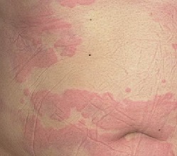 Allergisk urtikaria på magen
