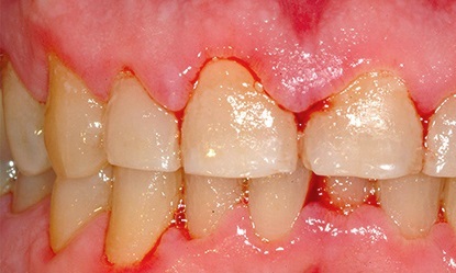 Síntomas de la gingivitis